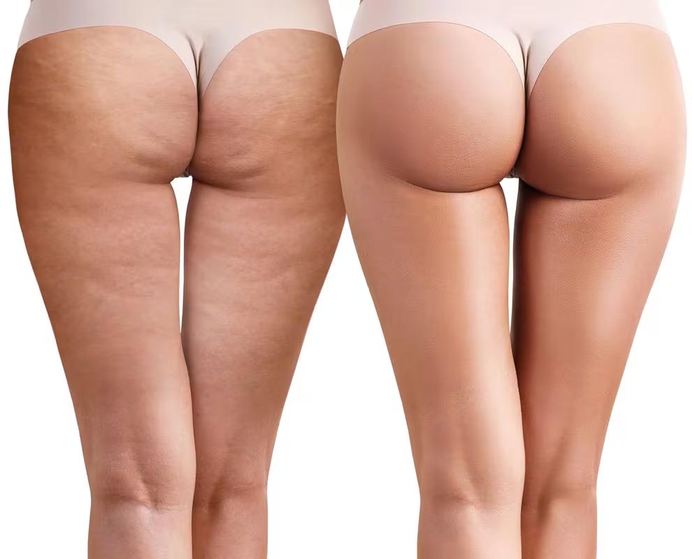 Cellulite before and after results